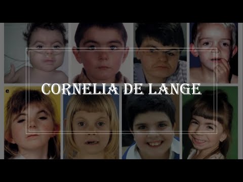 Cornelia de Lange syndrome features -  how to recognize craniofacial, feeding, limb abnormalities?