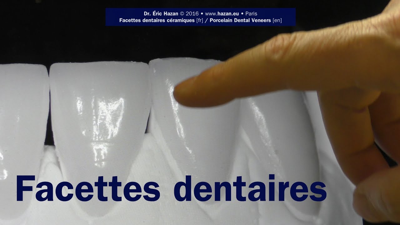 Facettes dentaires  - No #15+ (etapes) - Dr. Éric Hazan, Paris 16