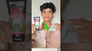 Garnier Men Acno Fight Anti Pimple Face Wash Salicylic Acid Face Wash