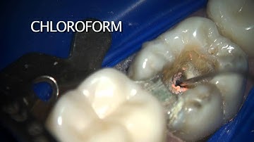 GuttaCore Retreatment technique | Dentsply Sirona