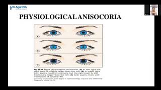 Physiological Anisocoria - Explanation by Dr Soundari S