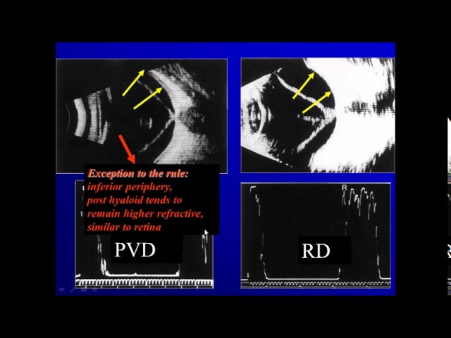Ophthalmic ultrasonography : 3 Retinal detachment