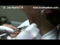 Botox Injection to Neck Bands (Platysma Muscle) by Dr. Joe Niamtu, III