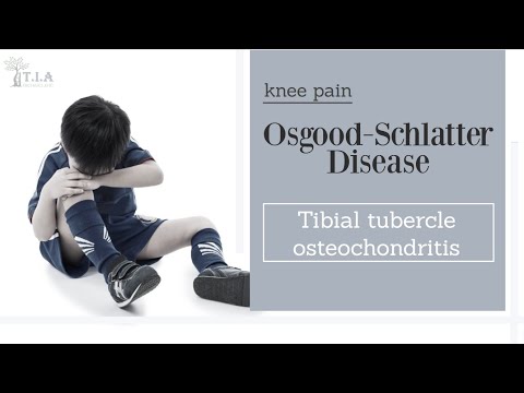 Video: Osgood Schlatters xəstəliyinin ağrısını necə azaltmaq olar: 11 addım