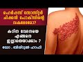        dr bishurul hafi  herpes zoster malayalam health