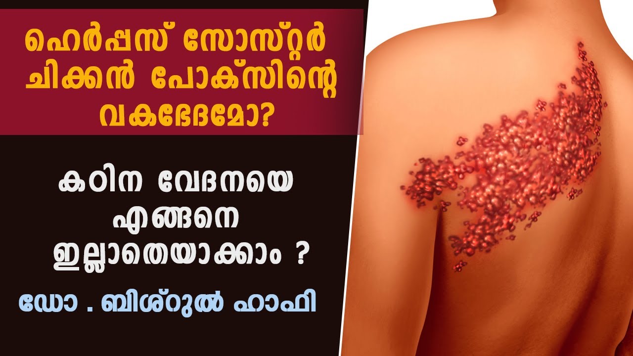 ഹെർപ്പസ്  സോസ്റ്റർ  ചിക്കൻ പോക്സിന്റെ വകഭേദമോ? Dr. Bishurul Hafi | Herpes Zoster Malayalam health