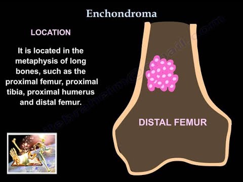 Enchondroma - Everything You Need To Know - Dr. Nabil Ebraheim