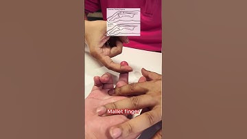 "Road to Recovery: Healing Mallet Finger with Effective Physiotherapy Treatment"