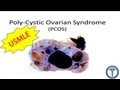 Polycystic Ovarian Syndrome (PCOS) - MADE EASY