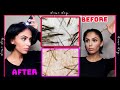Exfoliating My Scalp Under A Microscope - Scalp Detox Treatment Before & After (INSANE)
