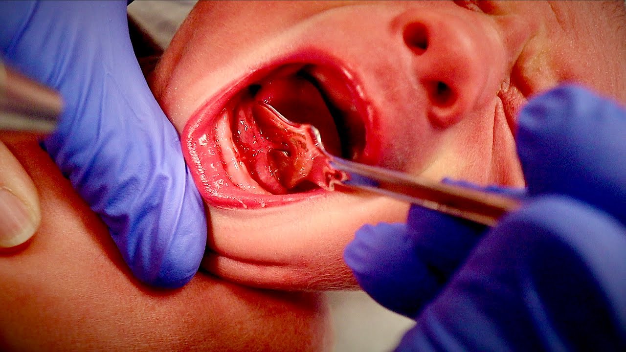 TONGUETIE SURGERY ON NEWBORN Dr. Paul YouTube