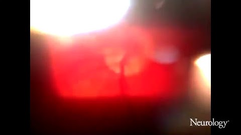 Teaching Video NeuroImages: Video-opthalmoscopy: Nystagmus from the inside [2/2]