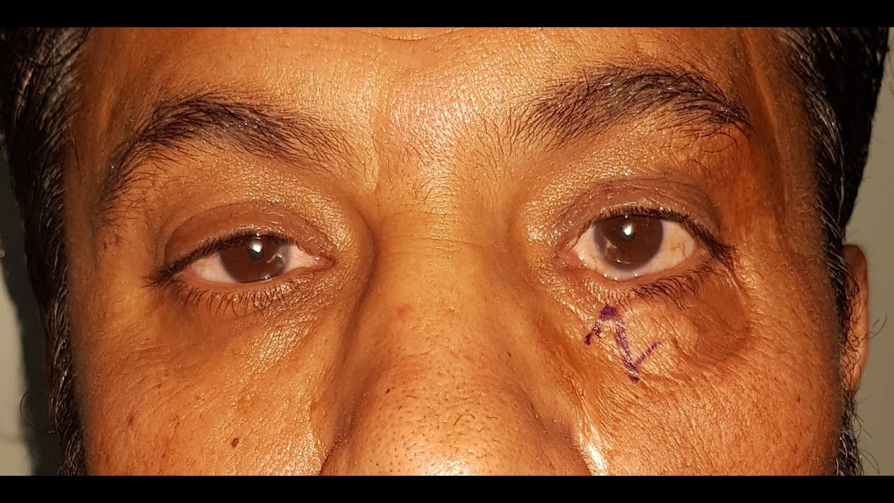 ZPlasty for lower eyelid notching YouTube