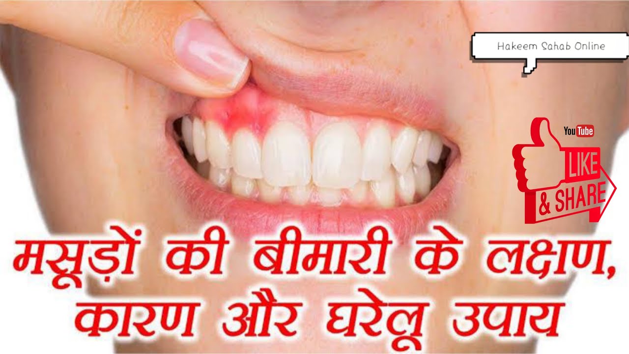 मसूड़े की बीमारी को कैसे पता लगाये | Masoode ki bimari ko janiye aur ...