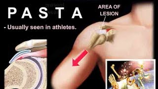Lesions Of The Shoulder PASTA Lesions - Everything You Need To Know - Dr. Nabil Ebraheim