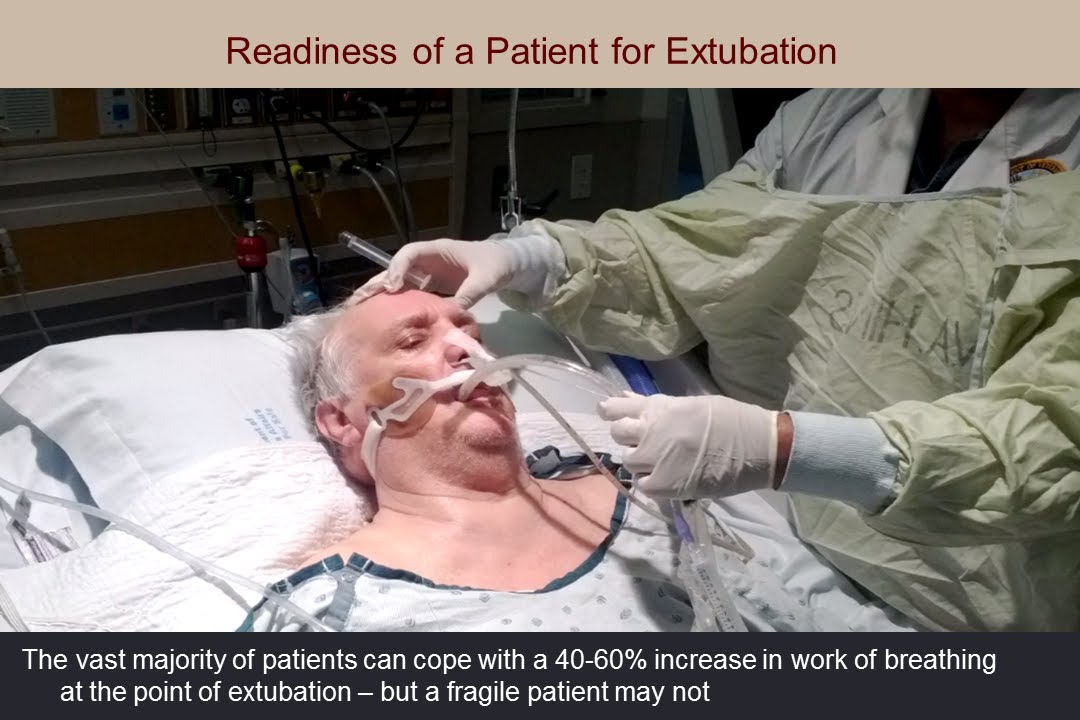 (Engl) 25 Years of Weaning  Martin Tobin