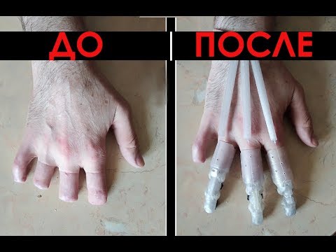 ПРОТЕЗ ПАЛЬЦА. Функциональный протез на 3 пальца. Обморожение (указательный, средний, безымянный)