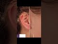 Reno Torn Earlobe Repair by Dr. Erez Dayan 👂