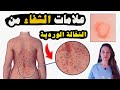 علامات الشفاء من النخالة الوردية اسمعها