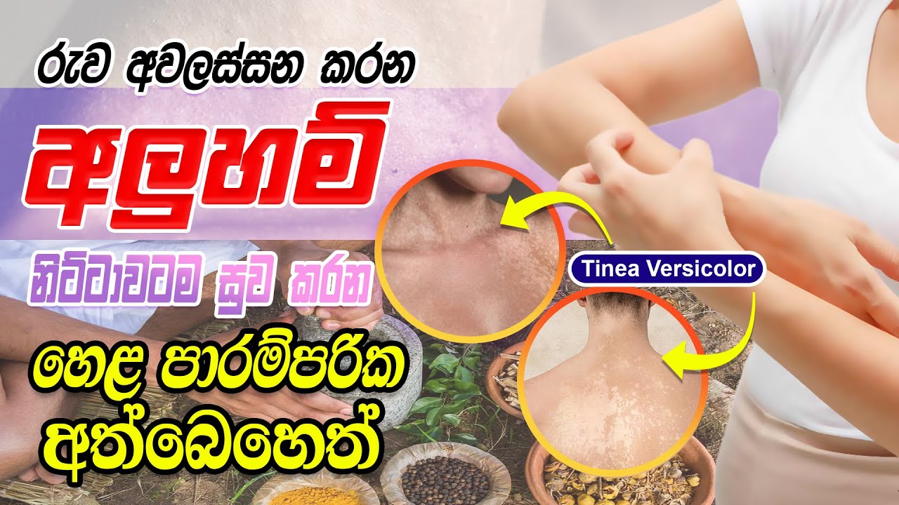 tinea versicolor treatment sinhala aluham walata beheth අලුහම් වලට