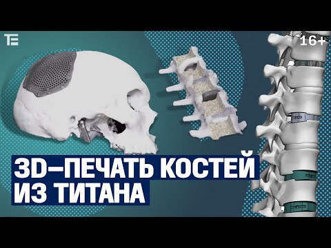 Российская компания печатает кости! Медицинская 3D-печать титановых имплантов