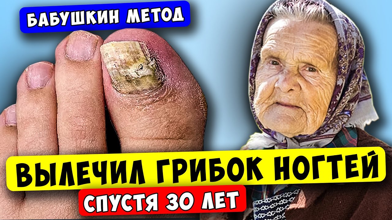 ГРИБОК НОГТЕЙ ушел Вон, когда Я приложил Обычный... Бабушкин Способ ...