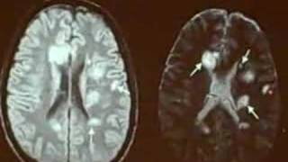 MRI of Multiple Sclerosis