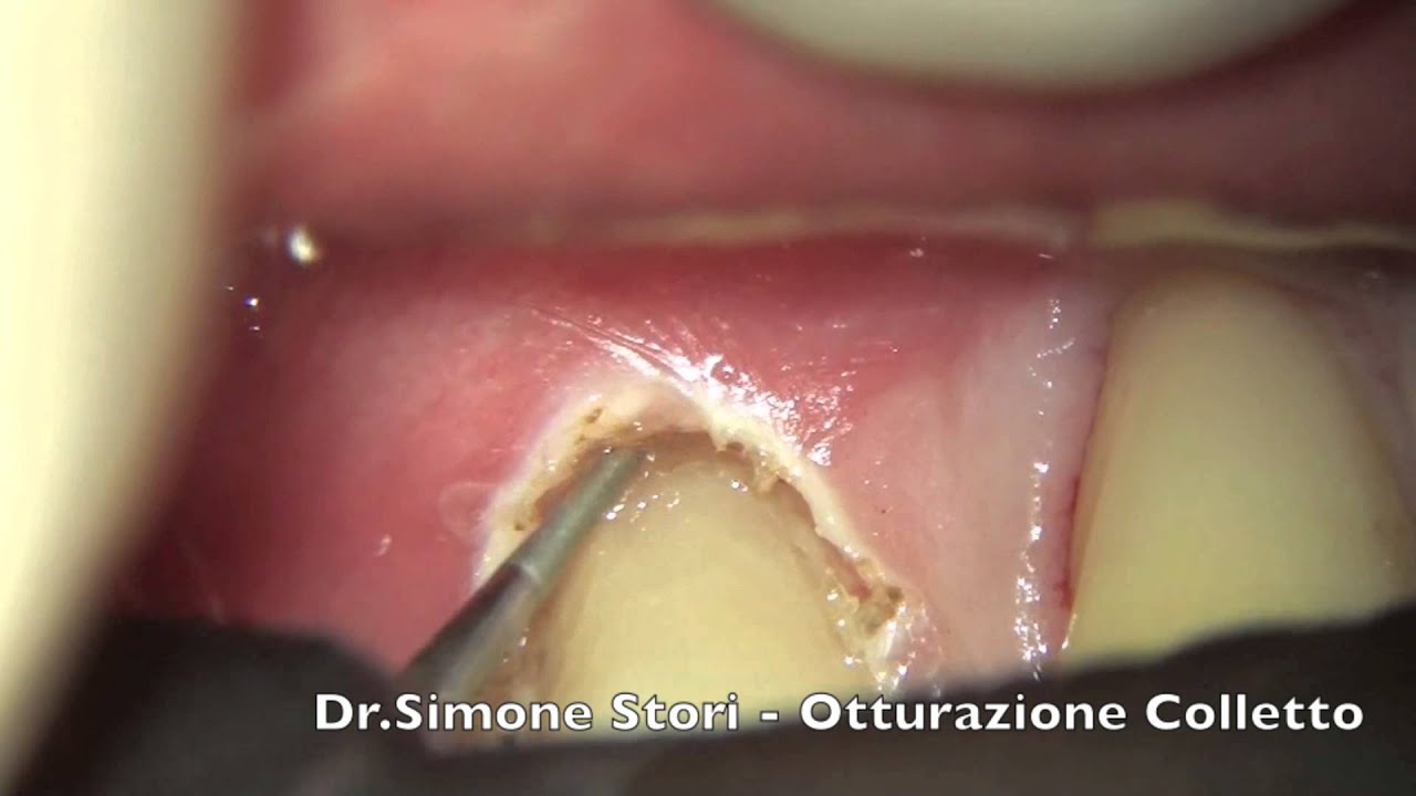 Otturazione Colletto Dentale Prima E Dopo Otturazione Estetica al Colletto Dentale - Estetica Dentale - YouTube