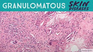 Granulomatous Skin Diseases 101: Dermpath Basics for Dermatology Pathology & USMLE