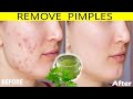 How to remove pimples overnight  acne treatment  maniaca beauty