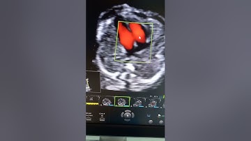 Video 190: Protocol siêu âm sàng lọc bất thường cấu trúc tim thai của mình