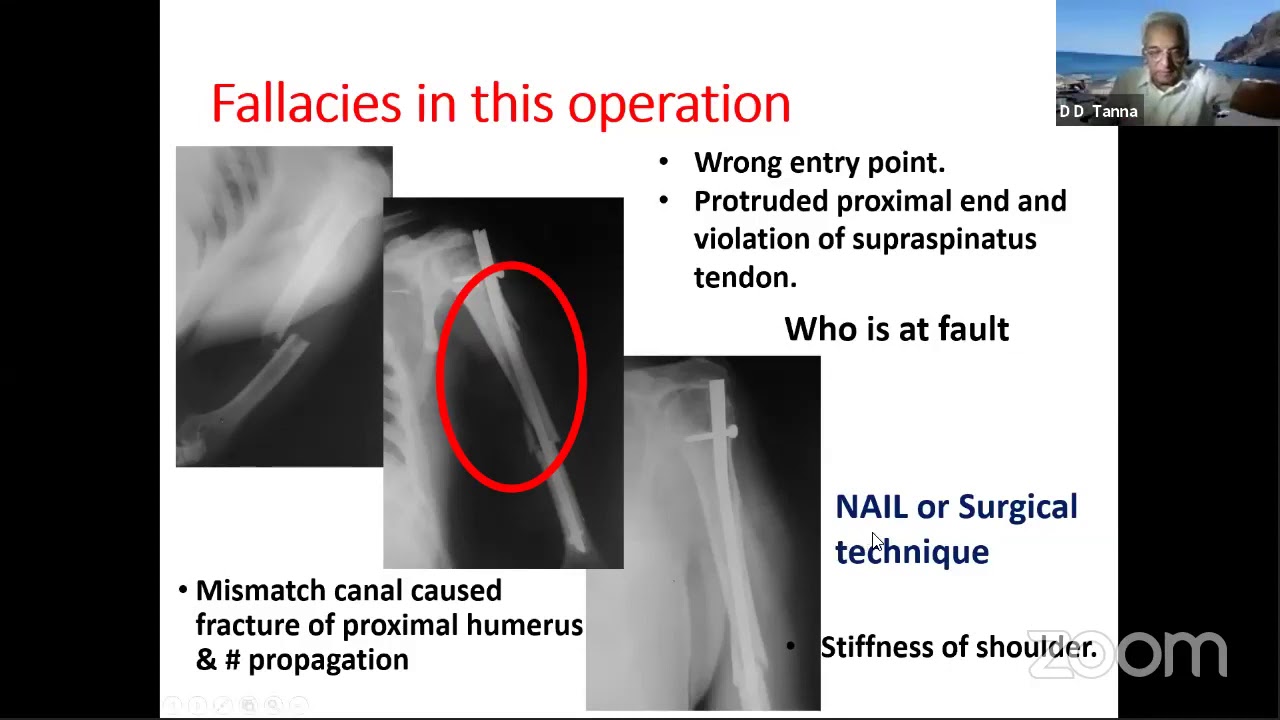 Surgical Treatment of Humeral Shaft Fractures by Arthroscopy-assisted  Intramedullary Nail Fixation. - Document - Gale Academic OneFile