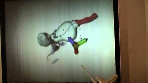 Medical Visualization with New Generation Spatial 3D Displays