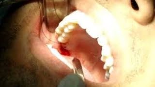 Ele EXTRAIU UM DENTE e Foi Parar na UTI Morte por INFECÇÃO DENTÁRIA