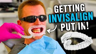 I Got Invisalign… Here’s Week 1!