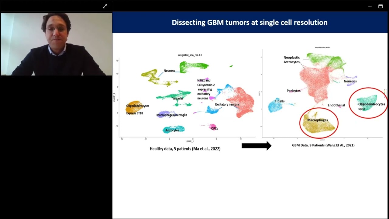Multivalent RNA CAR-T cell for malignant glioma