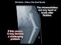 IM Rods, When The Rod Bends - Everything You Need To Know - Dr. Nabil Ebraheim