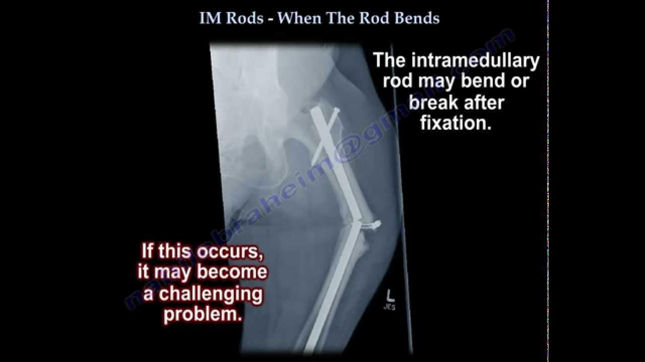 IM Rods, When The Rod Bends - Everything You Need To Know - Dr. Nabil  Ebraheim 