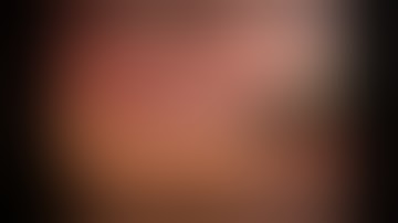 Laparoscopic D2-gastrectomy for advanced gastric cancer