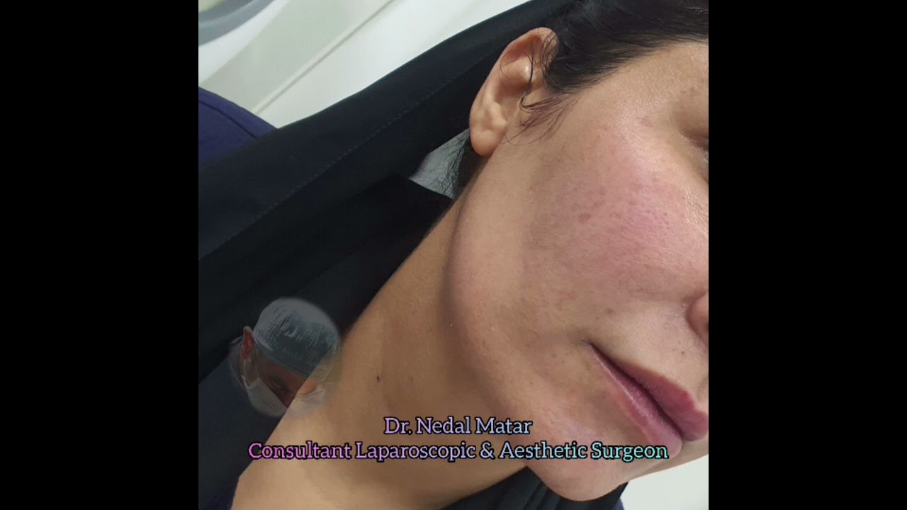 عملية تنحيف الخدود تحت تخدير موضعي Buccal Fat Removal