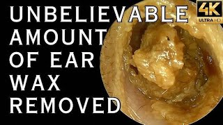 ASMR 고막에 붙은 딱딱한 귀지 제거 (Hard Earwax Removal) #earcleaning #asmr #satisfying #earwax removal