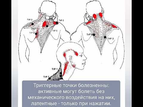Триггерные точки -