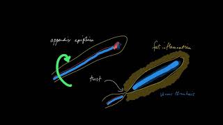Epiploic appendagitis: what the heck is that
