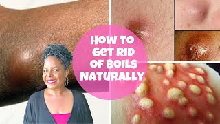 HOW TO GET RID OF BOILS NATURALLY screenshot 5