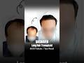 Unshaven Long Hair Transplant | 6000 Follicles 1 Year Result #shortvideo