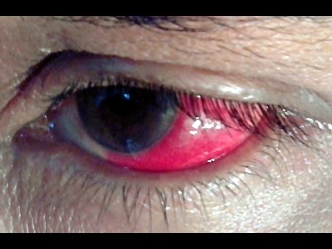 Video: 10 Causes Of Eye Redness