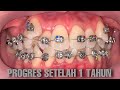 1 TAHUN BEHEL METAL | Dentist | Dokter Gigi Tri Putra