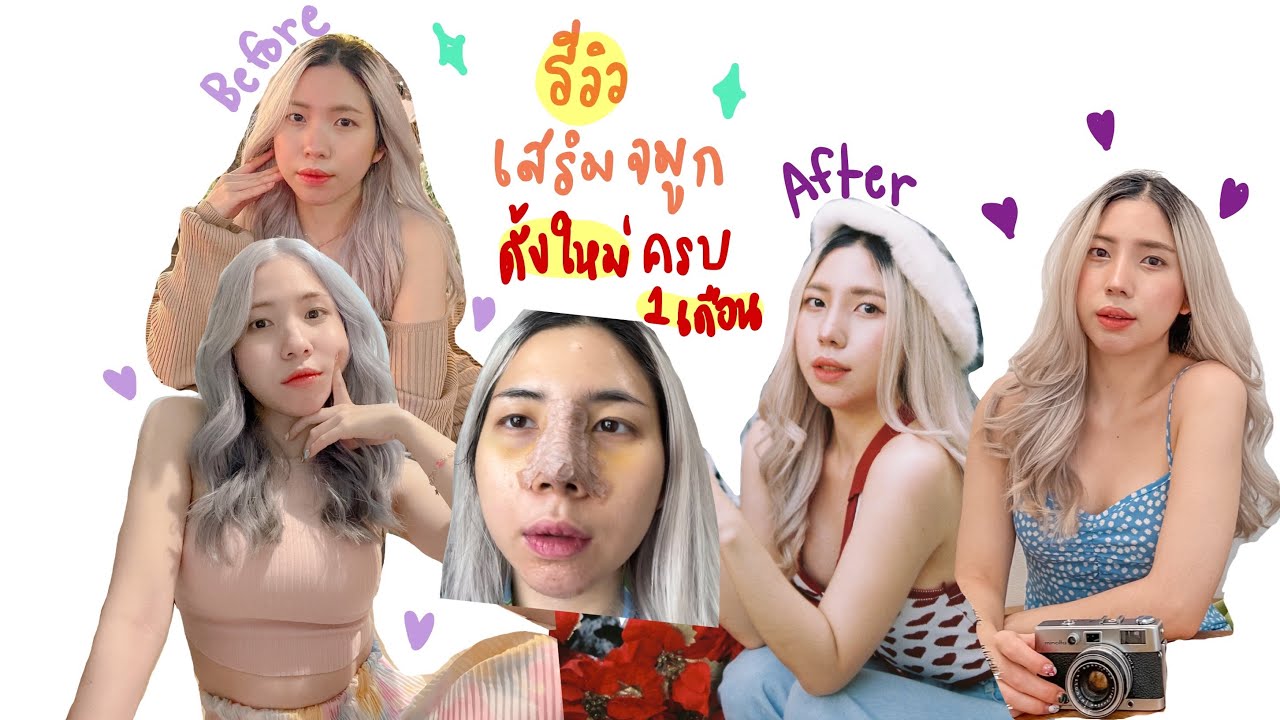รีวิวเสริมจมูก👃🏻ตั้งแต่วันแรกจนครบ1เดือน ดั้งแรกจะปังแค่ไหน!!👏🏻✨ myyppare🧸🌷