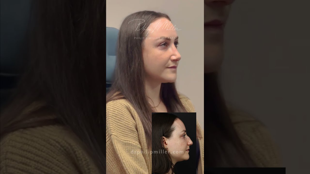 Three Months Post Op Rhinoplasty Results! What a transformation!