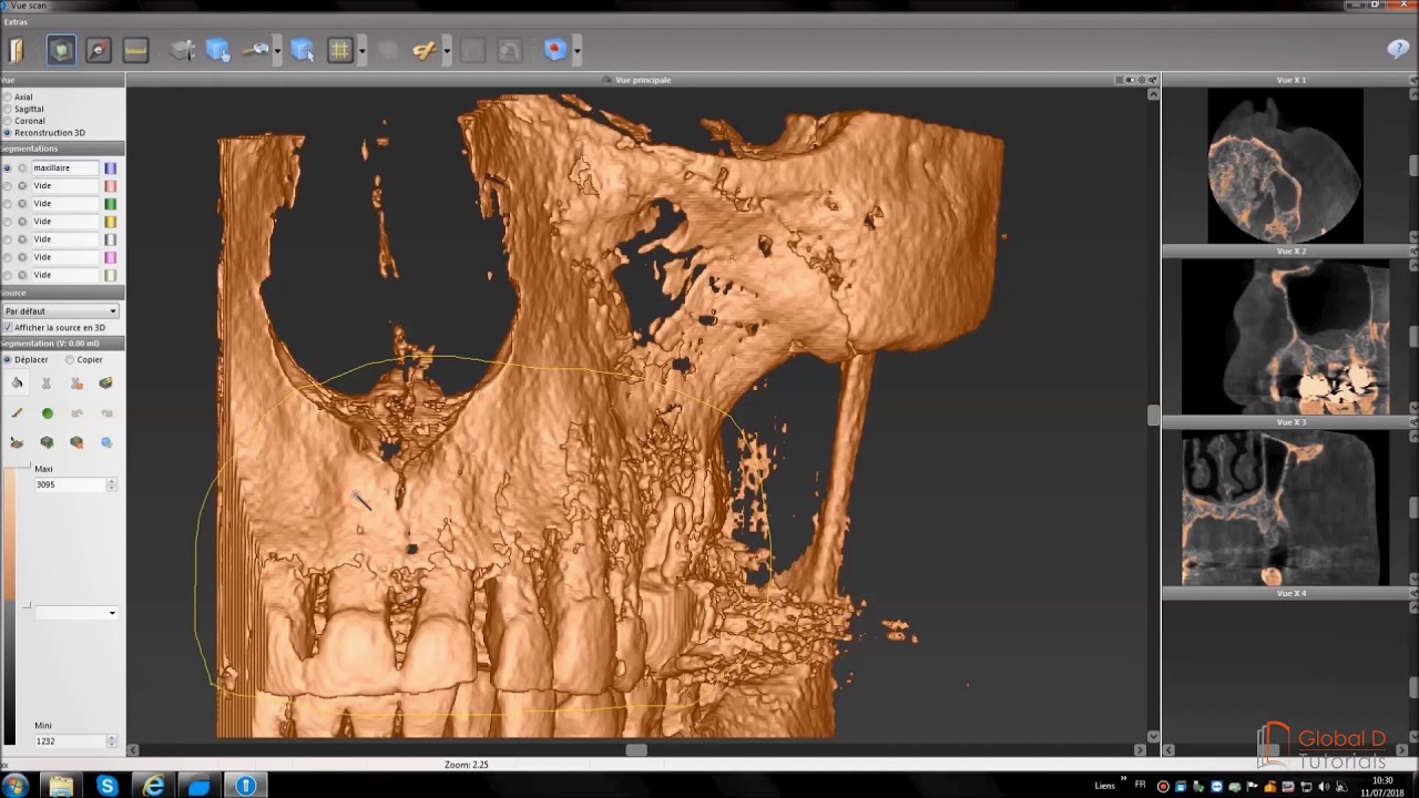 Tuto - Planification Implantaire
